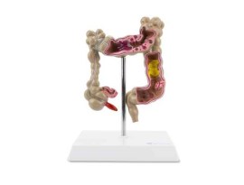 Colon Com Patologias Intestinais - Sd55
