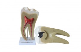 Dente Molar Ampliado Saudável E Com Cárie - TGD-0311-B