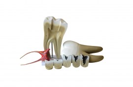 Dente Molar Ampliado Com Evolução Da Cárie Em 8 Partes - TGD-0311-G